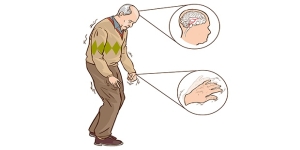 Il Mini Mental Parkinson Test (MMPT): il MMSE per la malattia di Parkinson