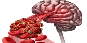 La demenza Vascolare e la Hachinski Ischemic Scale (HIS)